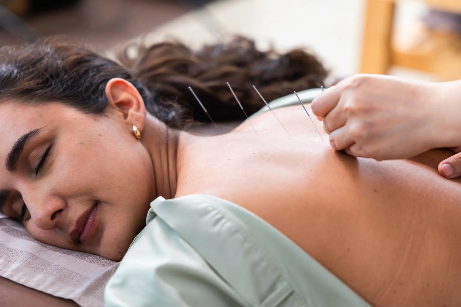 acupuncture